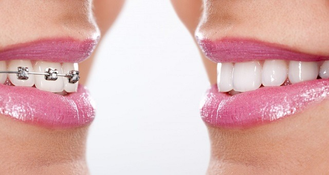 Affordable Braces Sacramento
