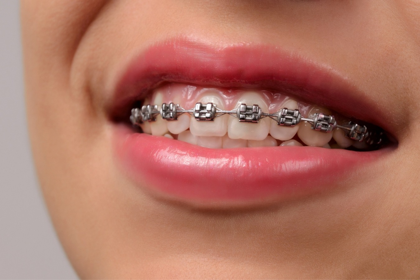 Braces Cost Sacramento
